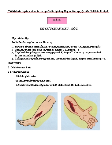 Tài liệu Huấn luyện sơ cấp cứu cho người dân - Bài 5: Sơ cứu chảy máu. Sốc